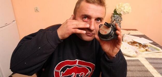 Polscy lekarze nie pomogli. Sam zoperował sobie oko!