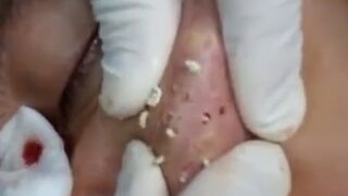 Wyciskanie pryszczy na twarzy - Mocne!